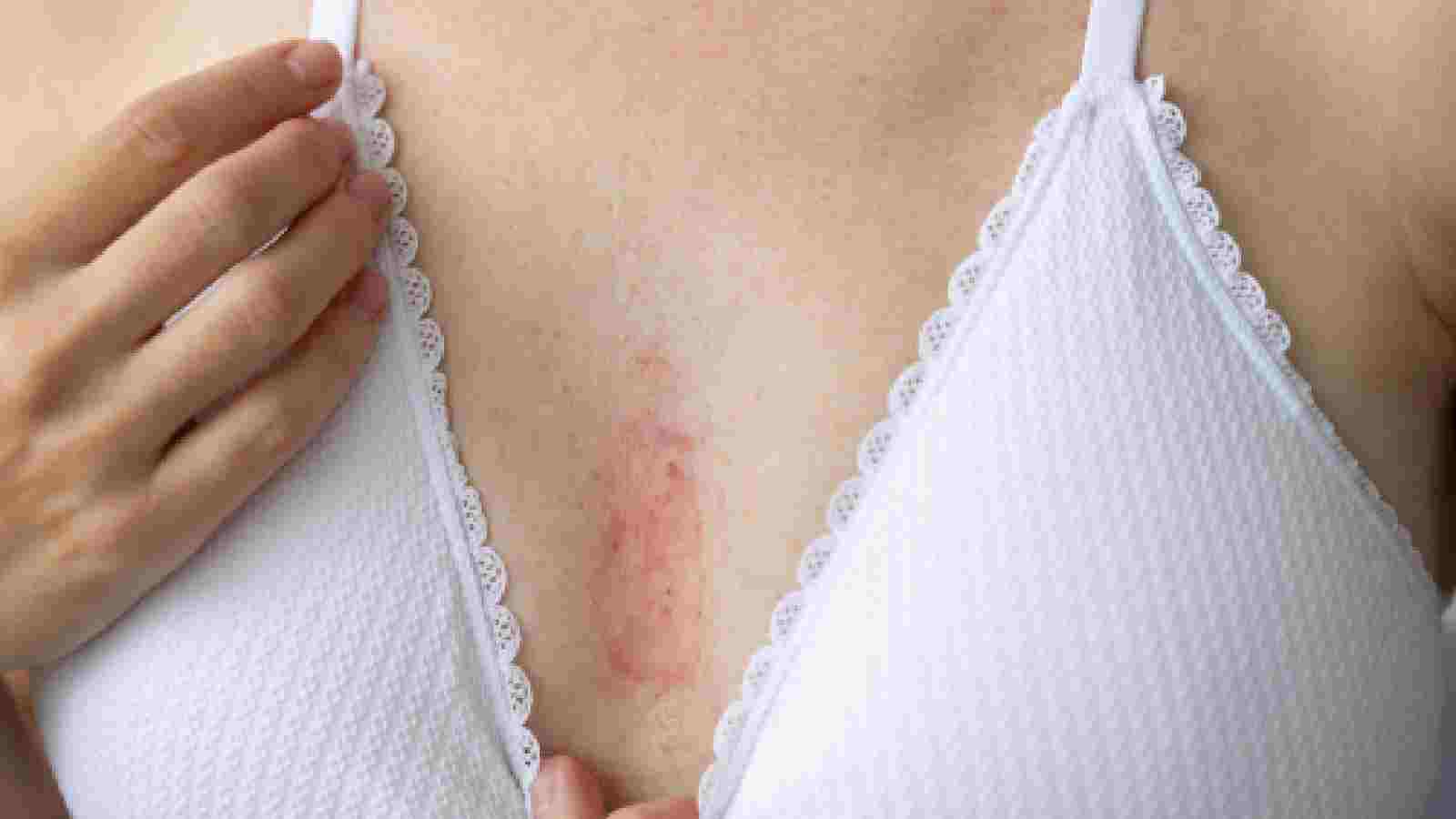 1716396012 Remedies for underboob rashes Remedies for underboob rashes