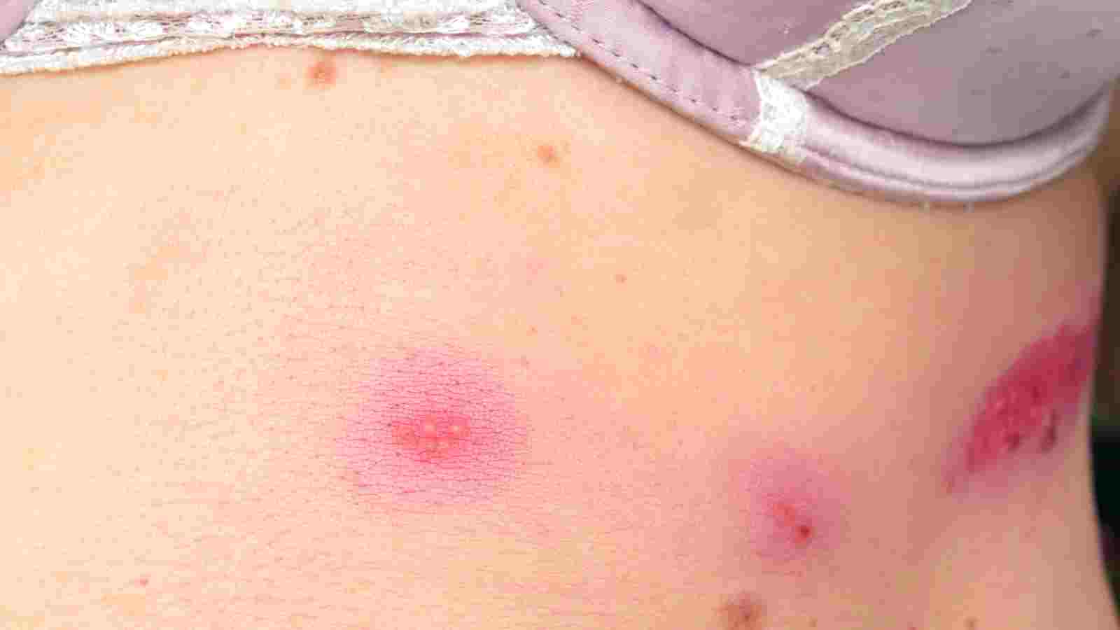 causes of breast rash